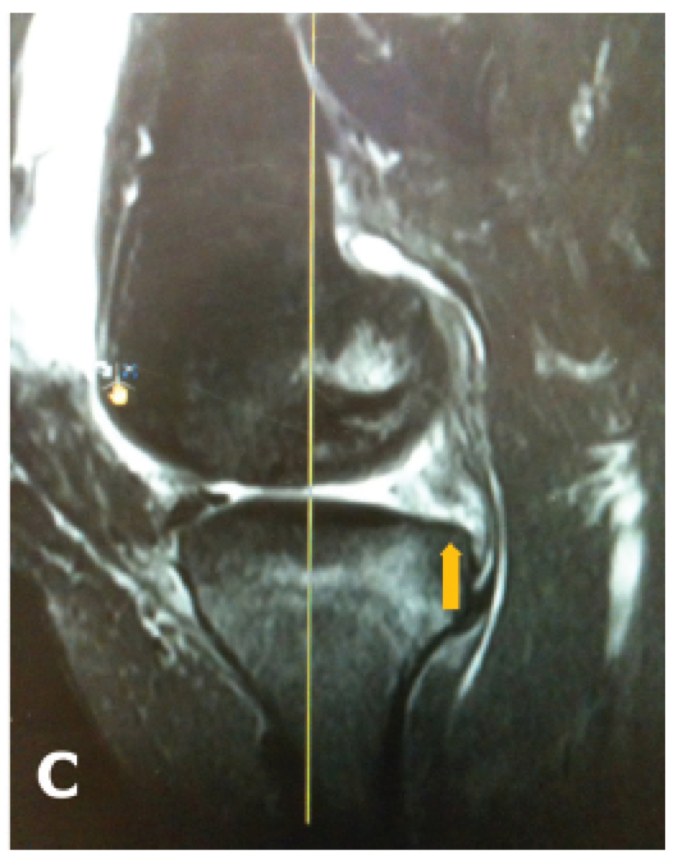 MRI Meniscal Root Tear 3